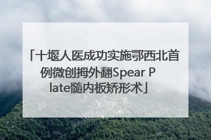 十堰人医成功实施鄂西北首例微创拇外翻Spear Plate髓内板矫形术